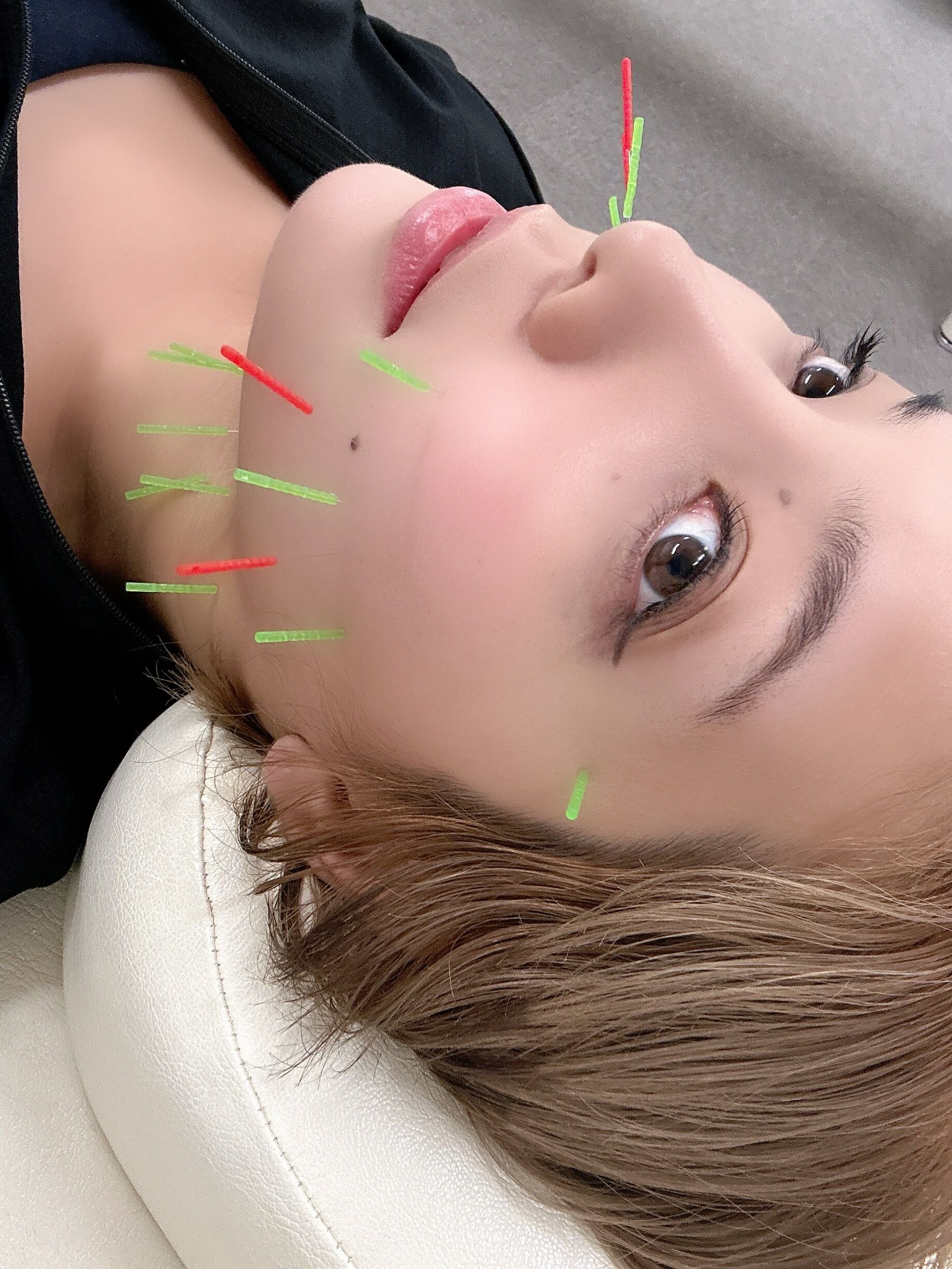 整体で美容鍼瑱