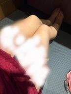 鞭痕あり