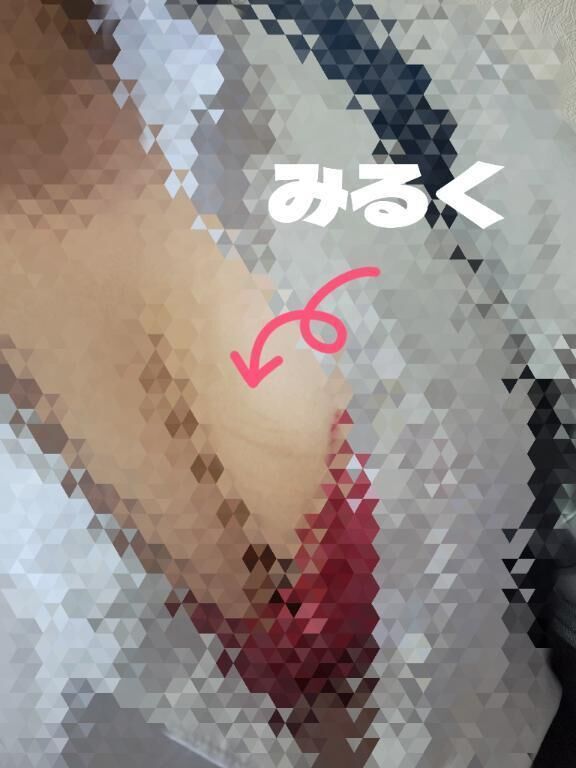 &#127868;痛かった&#129301;