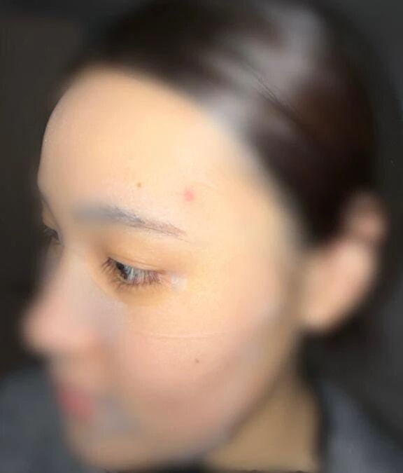 にきびがなおったらあーbyエビ中