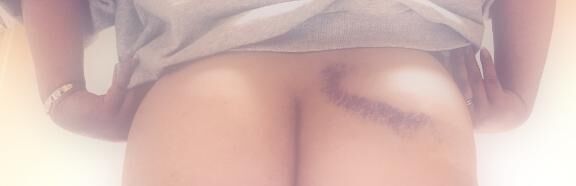 負傷(´；ω；｀)