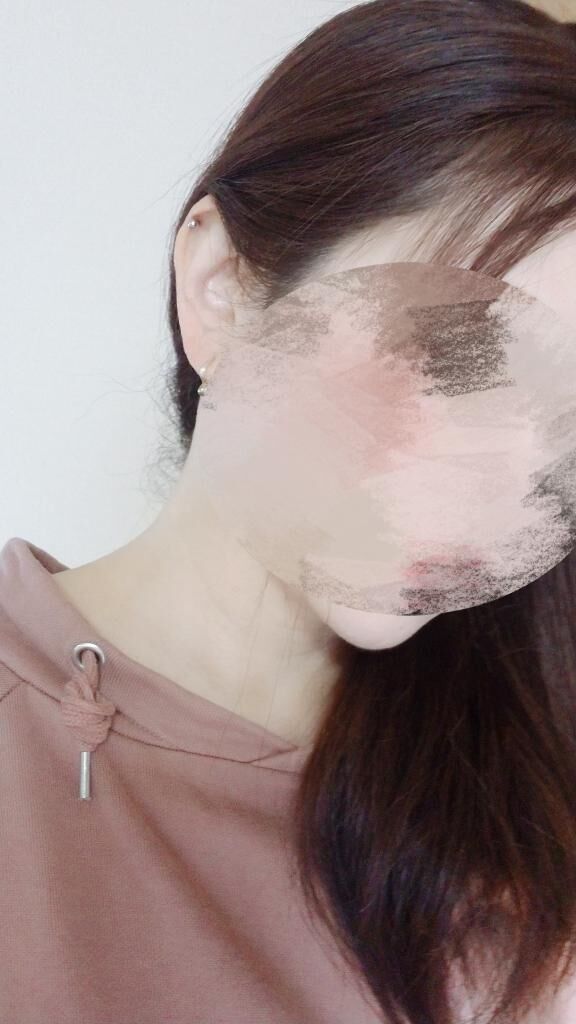 軟骨ピアス経過